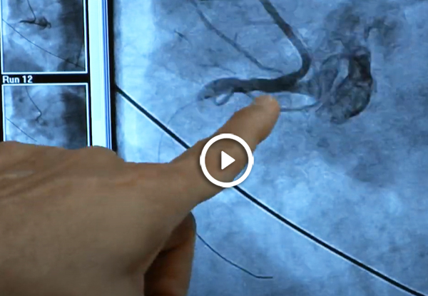 Having a Peek Inside Your Heart: Cardiac Catheterization