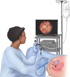 cystoscopy scope