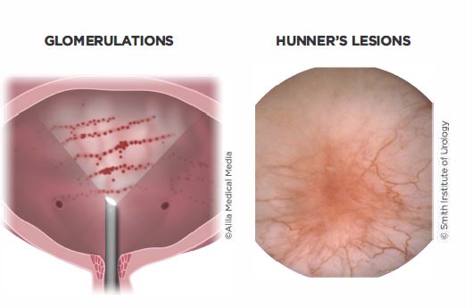 Interstitial cystitis Comprehensive Services For Women At CHI St