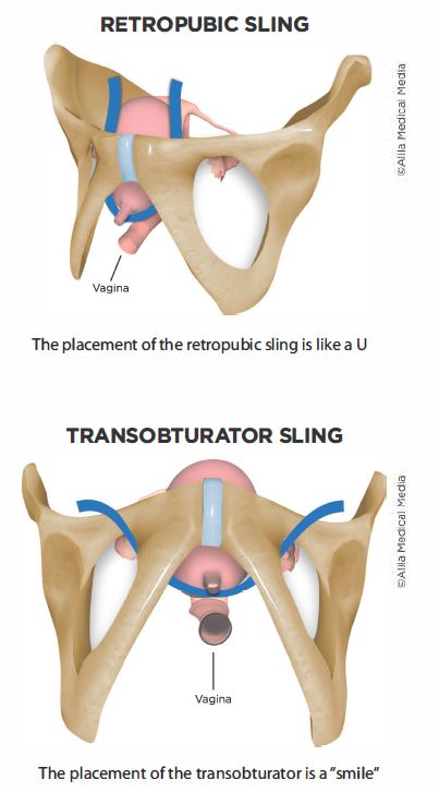 bladder sling surgery