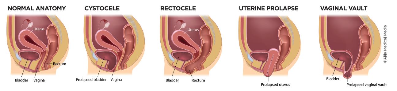 Uterine or Vaginal Vault Prolapse – Chicago Urogynecology