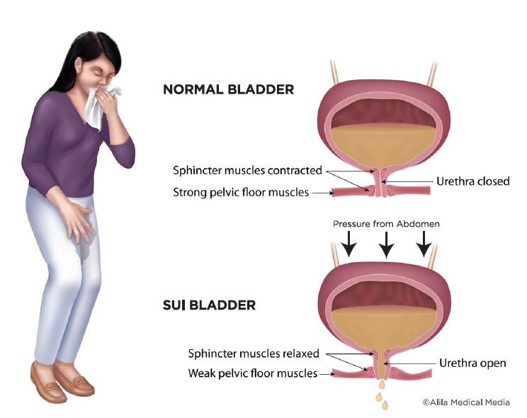 Causes amp Types of Stress Urinary Incontinence  Chicago Urogynecology